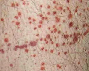 vasculita-l
