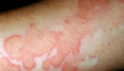 vasculita-l