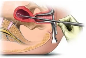 chiuretaj ginecologic