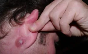 Tratamentul de inflamare a ganglionilor limfatici din spatele urechii Tratamentul de inflamare a ganglionilor limfatici din spatele urechii