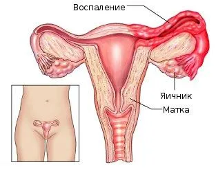 Inflamatia trata apendicelor