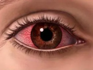 Alergia la ochi - cum să trateze pleoape de la produse cosmetice (tratate) Alergia la ochi - modul de a trata pleoape de la produsele cosmetice