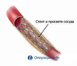 nave angioplastia (artere coronare), extremitatile inferioare, carotida