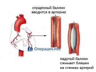 nave angioplastia (artere coronare), extremitatile inferioare, carotida