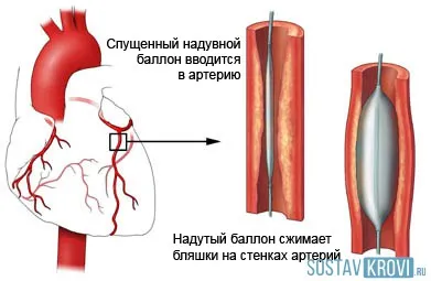 Angioplastia cu balon, coronariană, inima, vasele de sânge, membrele inferioare (inferior) Angioplastia cu balon, coronariene, inima, vasele de sânge, membrele inferioare