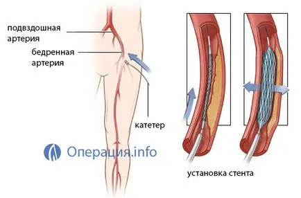 nave angioplastia (artere coronare), extremitatile inferioare, carotida