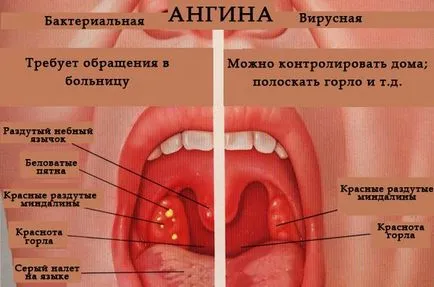 Tratamentul anginei la domiciliu rapid - modul de a trata remedii populare pectorale (condiții) Tratamentul anginei la domiciliu rapid - modul de a trata remedii populare anginoase