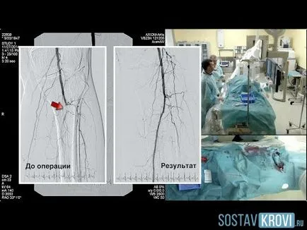 Angioplastia cu balon, coronariană, inima, vasele de sânge, membrele inferioare (vasele de sânge) Angioplastia cu balon, coronariene, inima, vasele de sânge, membrele inferioare