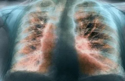 fibroza pulmonara bazala ce este, diagnostic și tratament