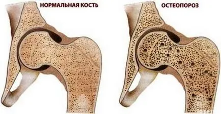 Bisfosfonații sunt ceea ce sunt și de ce trata in mod eficient osteoporoza