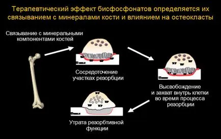 Bifosfonatii pentru tratamentul osteoporozei de eficacitate, pro și contra, recenzii (bifosfonați) Bifosfonatii pentru tratamentul osteoporozei de eficacitate, pro și contra, comentarii