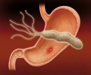 Boli ale stomacului și a cauzelor simptomelor, diagnostic, tratament, dieta, medicamente, plante aromatice, prevenirea