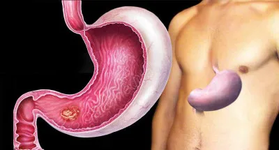 Boli ale stomacului lista de boli, simptome, tratament