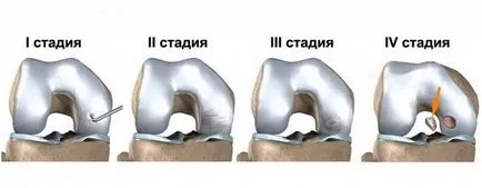 Koenig genunchi tratamentul bolilor articulare, cauze, simptome (boala) Koenig genunchi tratamentul bolilor articulare, cauze, simptome