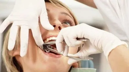 Doare dacă pentru a trage un dinte molar cu procedura de îndepărtare anestezie