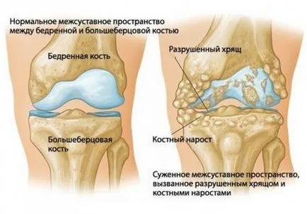 Cauzele bolii Koenig, simptome, diagnostic și tratament