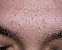 Tratamentul Blackheads și îndepărtarea Comedoanele deschise pe față și nasul unui copil (comedoane) Tratamentul Blackheads și îndepărtarea Comedoanele deschise pe față și nasul unui copil