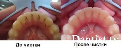 Spalatul pe dinti la prețul dentist și fotografii