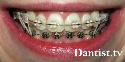 Spalatul pe dinti la prețul dentist și fotografii