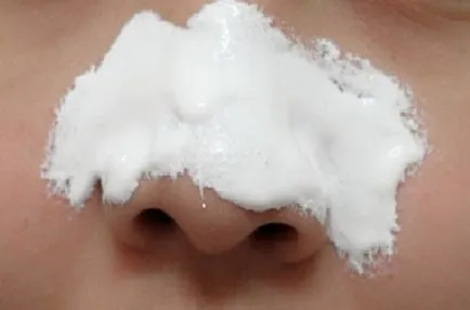 Tratamentul Blackheads și îndepărtarea Comedoanele deschise pe față și nasul unui copil (tratat) Tratamentul Blackheads și îndepărtarea Comedoanele deschise pe față și nasul unui copil