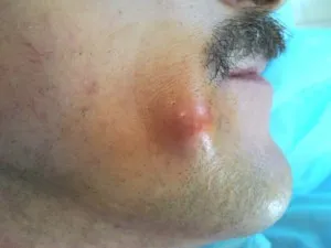 Ce se întâmplă dacă nu a existat Wen pe fata (fata) Ce se întâmplă dacă nu a existat Wen pe fata