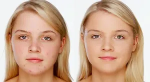 Că este un acarian piele cauze ale unei persoane, simptomele acarianului subcutanate pe fata si tratamentul (a) Că este un acarian de piele cauze ale unei persoane, simptomele de acarianul subcutanat facial și tratament