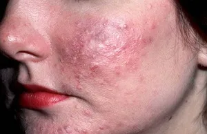 Că este un acarian piele cauze ale unei persoane, simptomele acarianului subcutanate pe fata si tratamentul (a) Că este un acarian de piele cauze ale unei persoane, simptomele de acarianul subcutanat facial și tratament