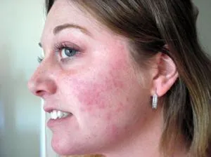 Că este un acarian de piele cauze ale unei persoane, simptomele de acarianul subcutanat facial și tratament (aspectul) Că este un acarian de piele cauze ale unei persoane, simptomele de acarianul subcutanat facial și tratament