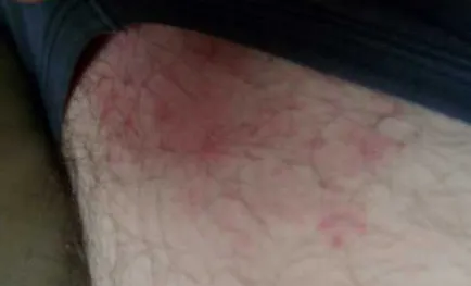 De ce este un om în inghinala apar roșeață, boli de piele