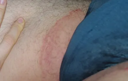 De ce este un om în inghinala apar roșeață, boli de piele