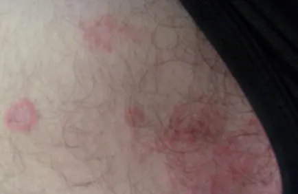 De ce este un om în inghinala apar roșeață, boli de piele