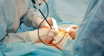 Ce este o procedură de reparare hernie