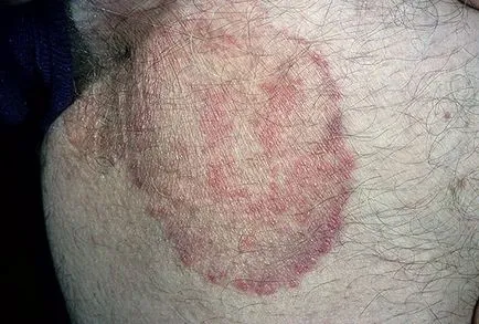 Clasificarea Tinea, agenți patogeni, diagnostic, tratament