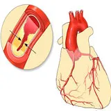Doza și medicamente pentru tratamentul anginei pectorale (medicamente, tablete) - care iau la adulți (medicamente) Doza și medicamente pentru tratamentul anginei pectorale (medicamente, tablete) - care au la adulți