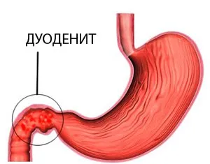 Duodenita - tratamentul remedii populare la domiciliu, dieta si nutritie (mijloace) Duodenita - tratamentul remedii populare la domiciliu, dieta si nutritie