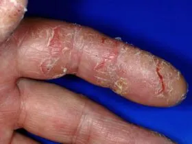 Eczema degetele principalele tipuri de dermatoze, în special manifestări și tratament (de bază) Eczema degetelor tipuri principale de dermatoze, în special simptome și tratament