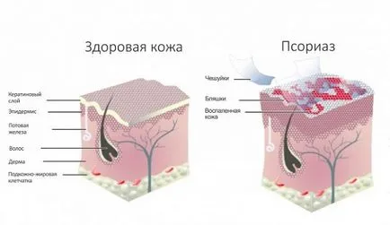 Eczema pe degete unguent disgidroticheskaya tratament între uscat
