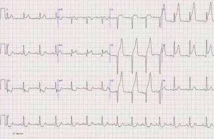 copil ECG