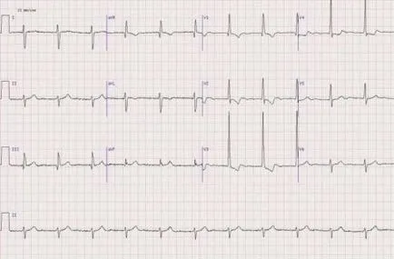 copil ECG