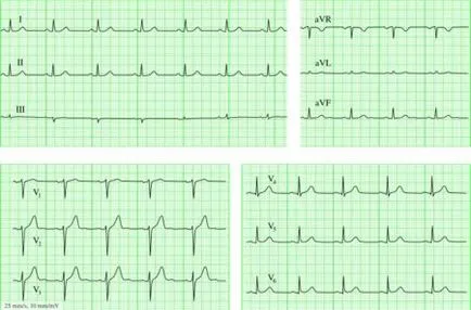 copil ECG