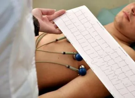 ECG infarct miocardic descifrare semne, localizare