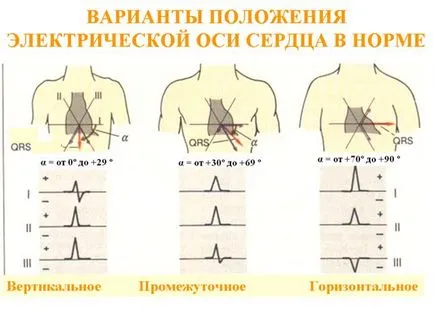 Eos (axa electrică a inimii) și deviația poziției (pachet din stânga) Eos (axa electrică a inimii) și deviația poziției