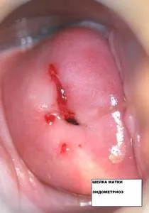 Fotografii de eroziune de col uterin (18 poze) (foto eroziunea colului uterin arata bolii) Fotografii de eroziune de col uterin (18 poze)
