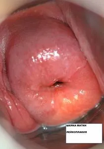 Fotografii de eroziune de col uterin (18 fotografii) (eroziune) Fotografii de eroziune de col uterin (18 poze)