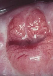 Fotografii de eroziune de col uterin (18 fotografii) (gât) Fotografii de eroziune de col uterin (18 poze)