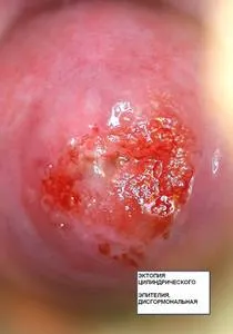 Fotografii de eroziune de col uterin (18 fotografii) (eroziune) Fotografii de eroziune de col uterin (18 poze)