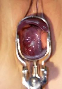 Fotografii de eroziune de col uterin (18 poze) (foto eroziunea colului uterin arata bolii) Fotografii de eroziune de col uterin (18 poze)