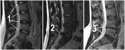 disc Foraminal herniat cauze, simptome și tratament