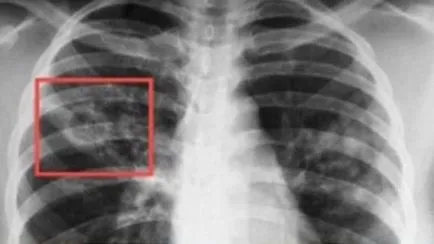 Piept de lumină cu raze X - ceea ce este necesar și ceea ce arată