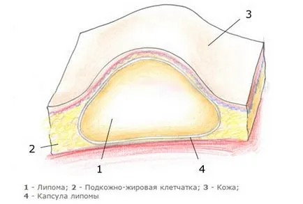 cauze de san Fibrolipoma si tratamente